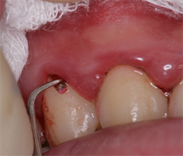 歯肉縁下の歯石除去
