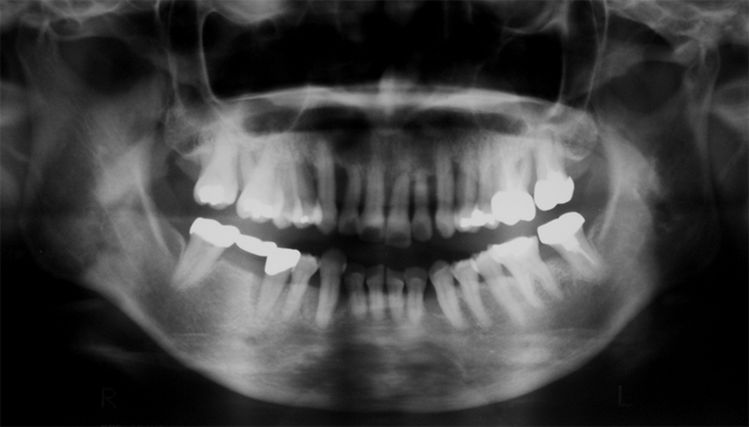 初診時パノラマレントゲン