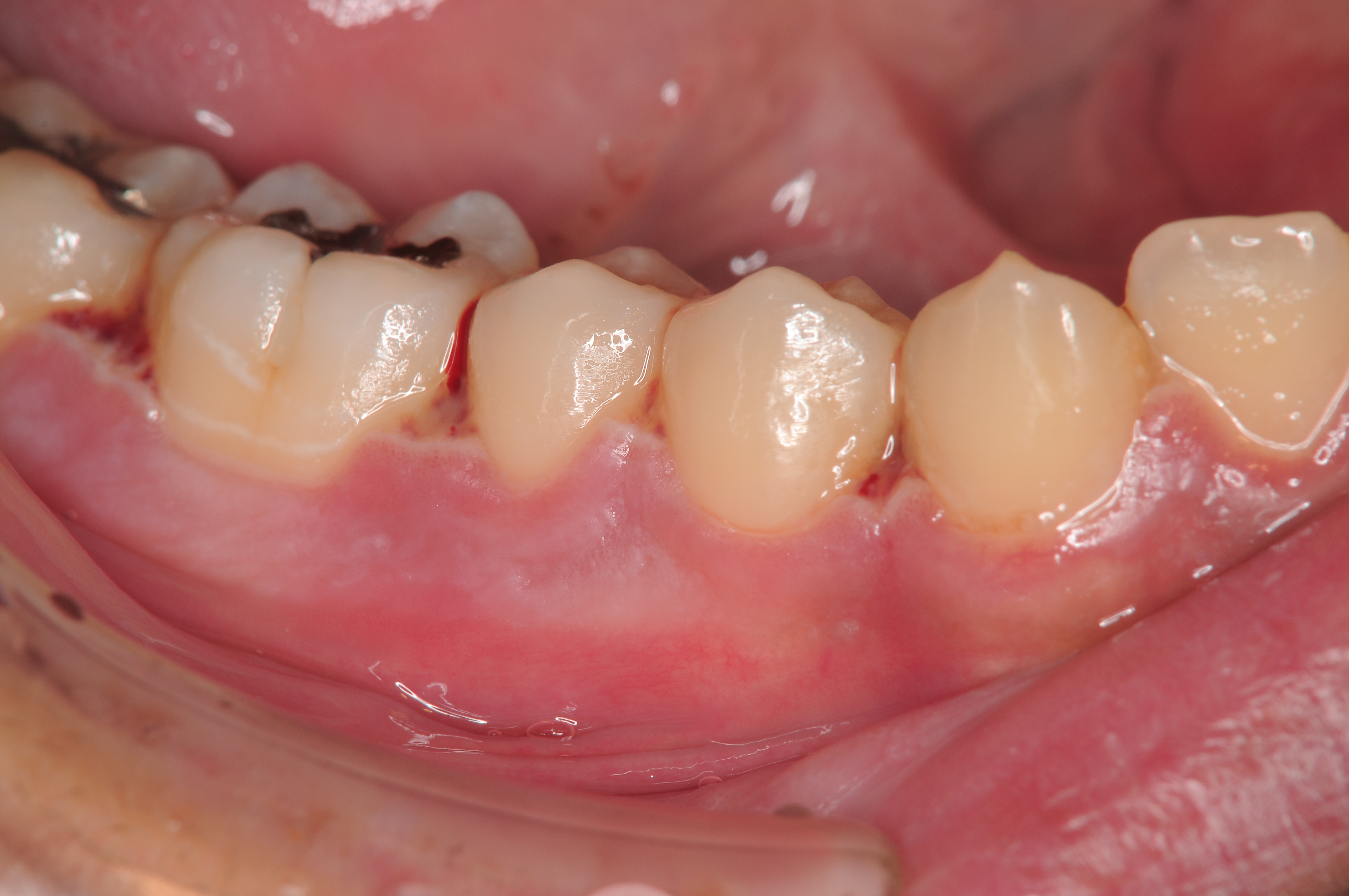 歯 周 病 喉 の 腫れ