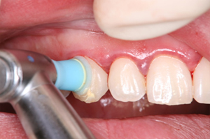 歯牙表面の研磨