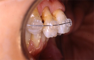 矯正治療：上顎前歯部