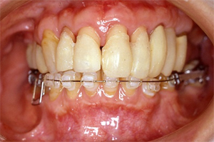 切端の位置及び歯冠長の調整
