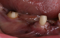 下顎右側臼歯部の抜歯