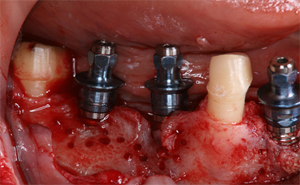 下顎右側臼歯部のインプラント治療