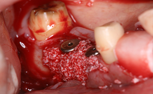 下顎右側臼歯部のインプラント治療