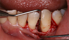 下顎左側臼歯部のFGG（遊離歯肉移植術）