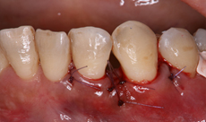 下顎左側臼歯部のFGG（遊離歯肉移植術）