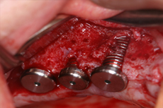 上顎右側臼歯部のインプラント治療