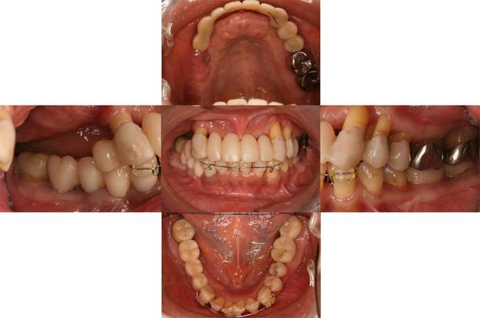 下顎前歯部の矯正開始