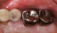 上顎左側臼歯部の抜歯