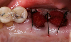 上顎左側臼歯部の抜歯