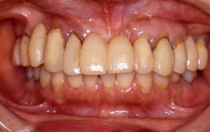 矯正治療後の仮歯と上顎の歯の状態