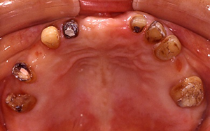 矯正治療後の仮歯と上顎の歯の状態