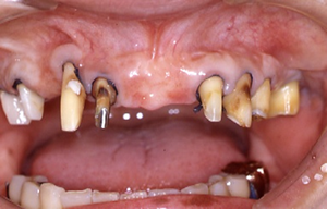 最終的な上顎の土台の歯の状態と補綴物