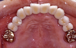 最終的な上顎の土台の歯の状態と補綴物