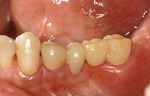 咬める状態ではあるが歯肉の状態が不十分