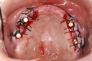 上顎のインプラントの2次オペ