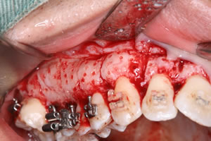 PAOO（歯周外科処置）術中写真：上顎