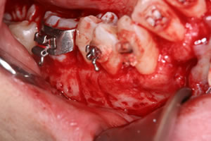 PAOO（歯周外科処置）術中写真：下顎