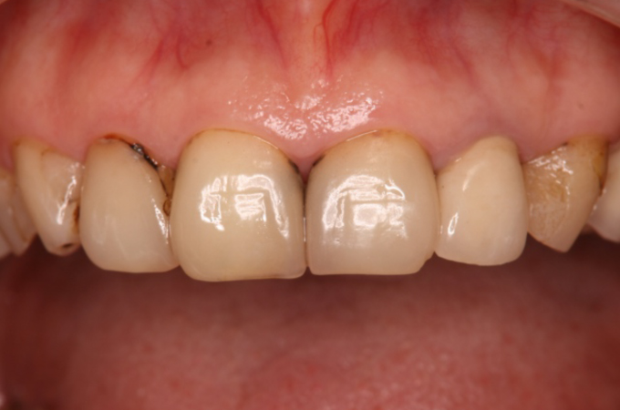 矯正治療：上顎前歯部