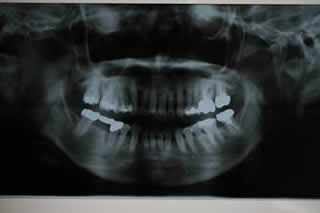 レントゲン（パノラマ）