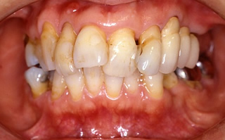 歯周病により歯並びが悪化