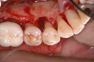 歯の根の周りの骨が大きく失われている